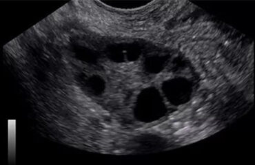 yperixos γυναικολογικός υπέρηχος