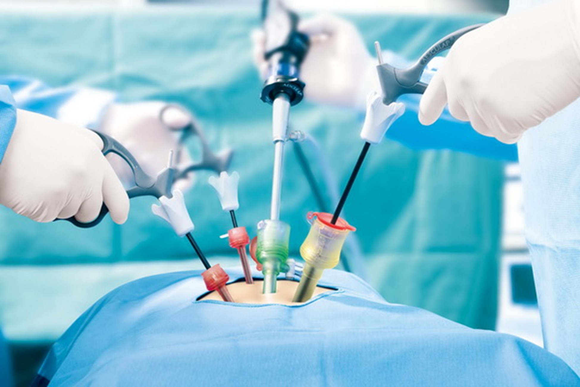 Laparoscopic λαπαροσκόπηση